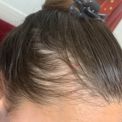 Diffuse Alopecia